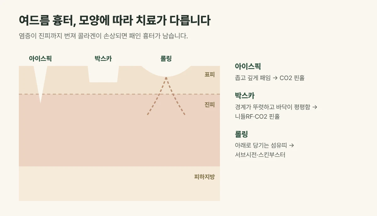 여드름 흉터 모양 그림: 좁고 깊은 아이스픽, 바닥이 평평한 박스카, 넓게 물결치는 롤링