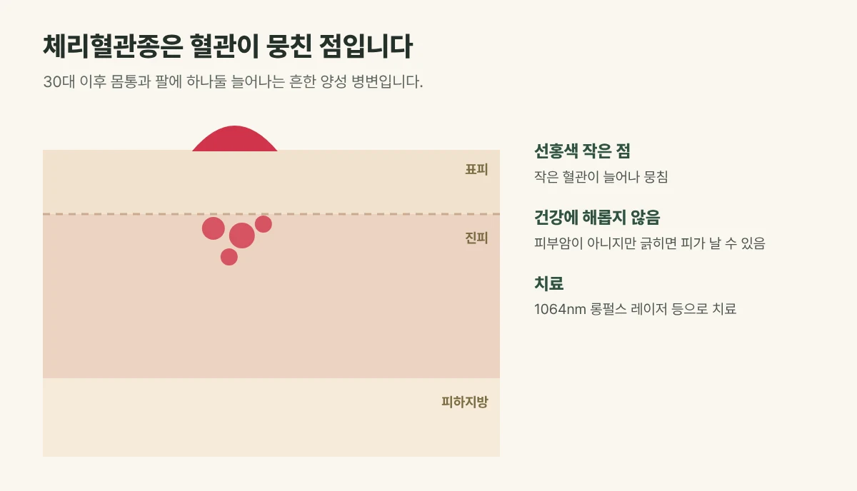 체리혈관종 피부 단면 그림: 작은 혈관이 늘어나 뭉친 선홍색 돌기