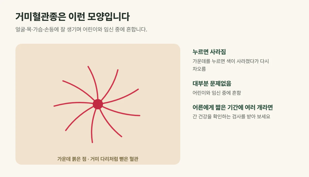 거미혈관종 그림: 가운데 붉은 점에서 가는 혈관이 거미 다리처럼 뻗은 모양